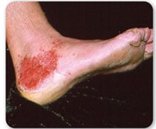 Vista lateral de pie mostrando enrojecimiento e irritación alrededor del tobillo