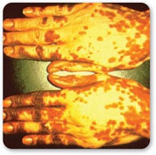 Vista superior de dos manos juntas mostrando áreas con pérdida de pigmentación