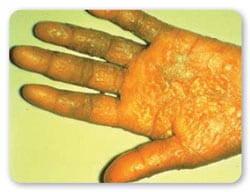 Vista de palma de la mano mostrando corrosión en la piel y ampollas