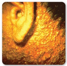 Vista lateral de la oreja y el cuello de una persona mostrando un caso grave de cloracné
