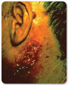 Vista lateral de la oreja y el cuello de una persona mostrando enrojecimiento y tumores de piel malignos