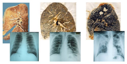 “Foto y radiografía de un pulmón normal (izquierda), con silicosis simple (centro) y con silicosis complicada (derecha). Los pulmones de las fotos son progresivamente más oscuros y los de las radiografías correspondientes muestran progresivamente mayor oclusión”.