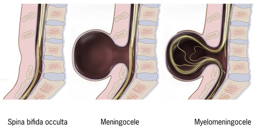 This image shows the three most common types of spina bifida. On the left is spina bifida occulta, in the middle is meningocele, and on the right is myelomeningocele.