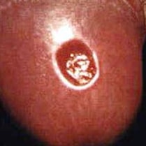 syphilis chancre on penis