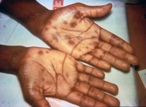 Secondary stage syphilis sores (lesions) on the palms of the hands. Referred to as palmar lesions.