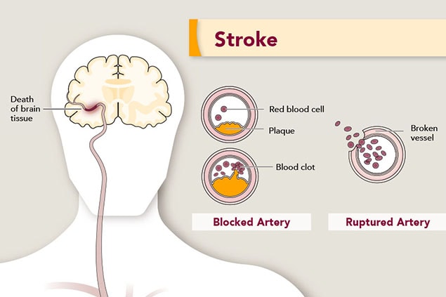 Illustration of what a stroke does to your brain.