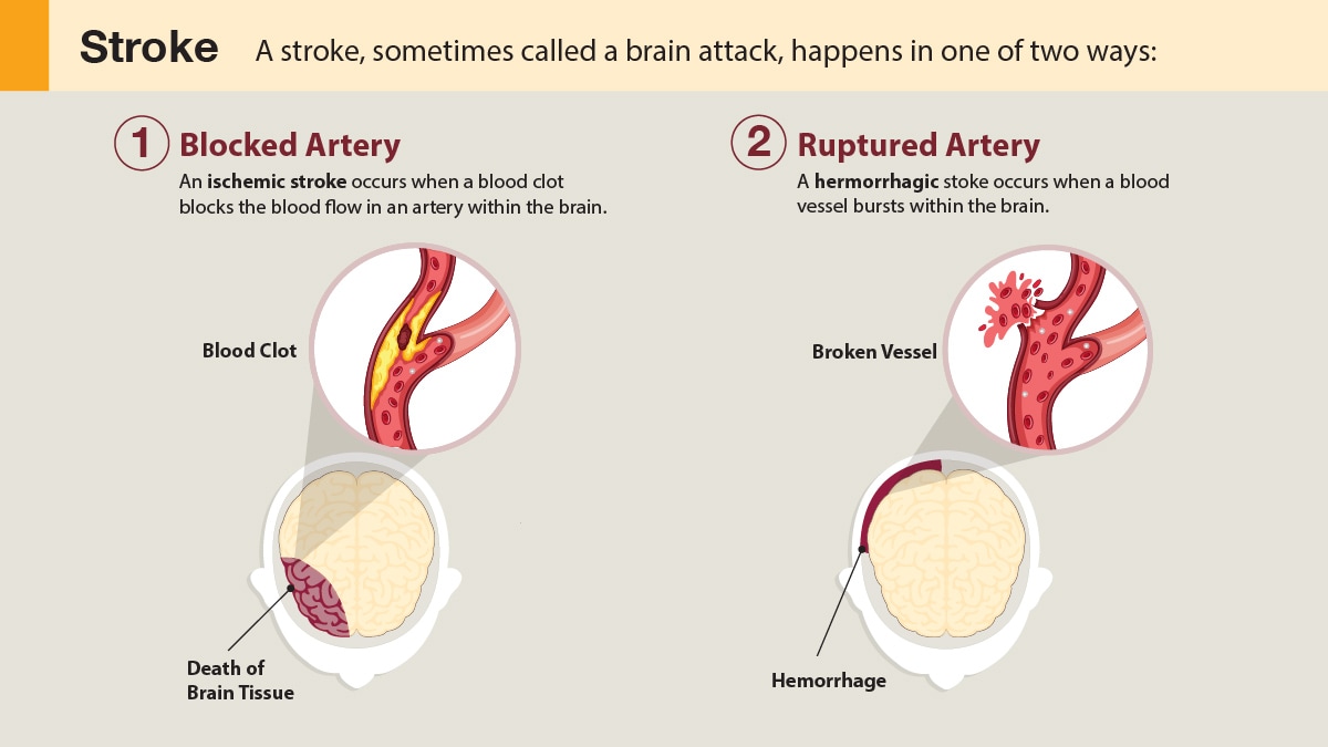 Illustration of a blocked artery in the brain and a ruptured artery in the brain.