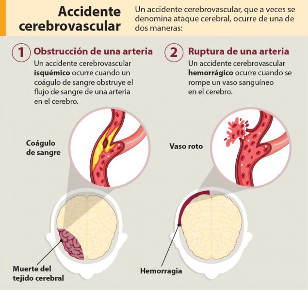 Un accidente cerebrovascular, que a veces se denomina ataque cerebral, ocurre de una de dos maneras: Obstruccion de una arteria; Ruptura de una arteria