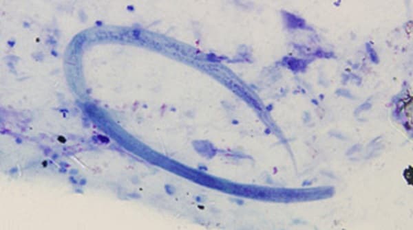 larva of S. stercoralis in a sputum specimen, stained with Giemsa.
