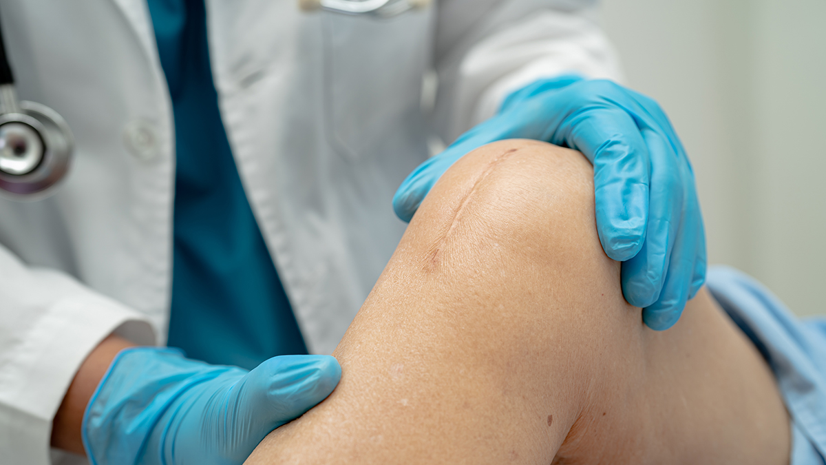 Surgical Site Infection Basics | SSIs | CDC