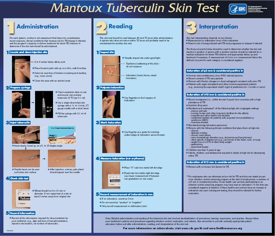 Mantoux Tuberculin Skin Test Wall Chart