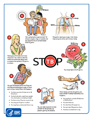 Stop TB poster