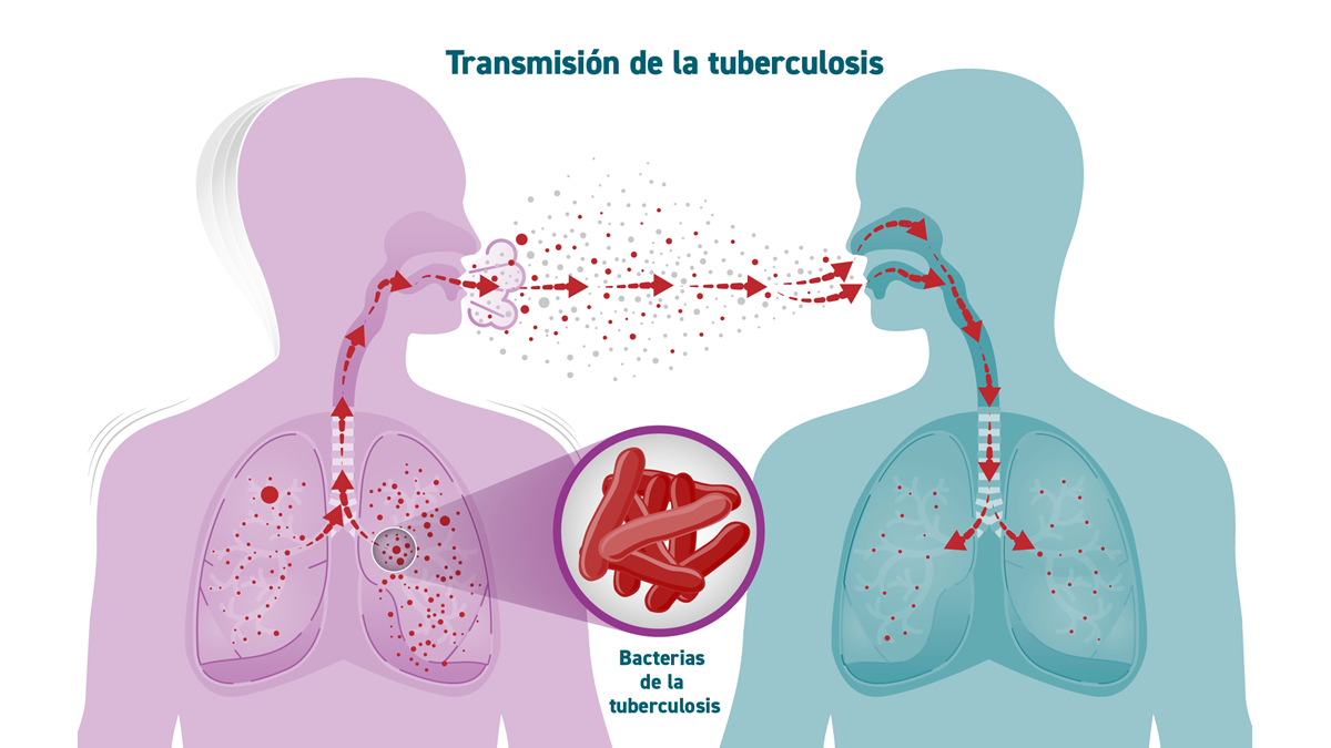 Tuberculosis: causas y cómo se propaga | Tuberculosis | CDC