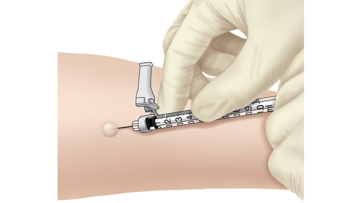 Illustration showing the correct way to administer the TB skin test