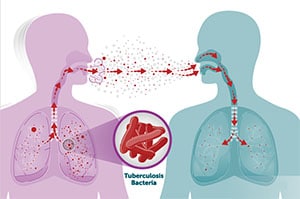 How tuberculosis spreads