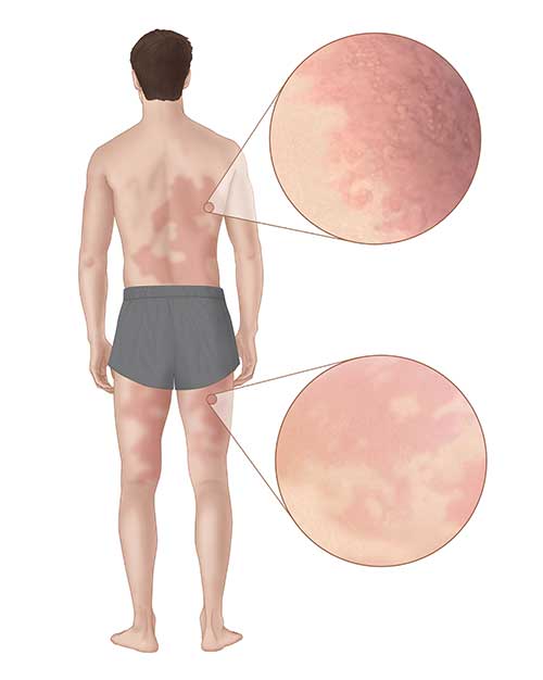 diagram of man's body showing red rash all over