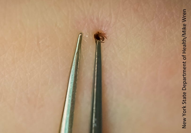 Photo from New York State Department of Health showing tweezers being used to grasp a tick.