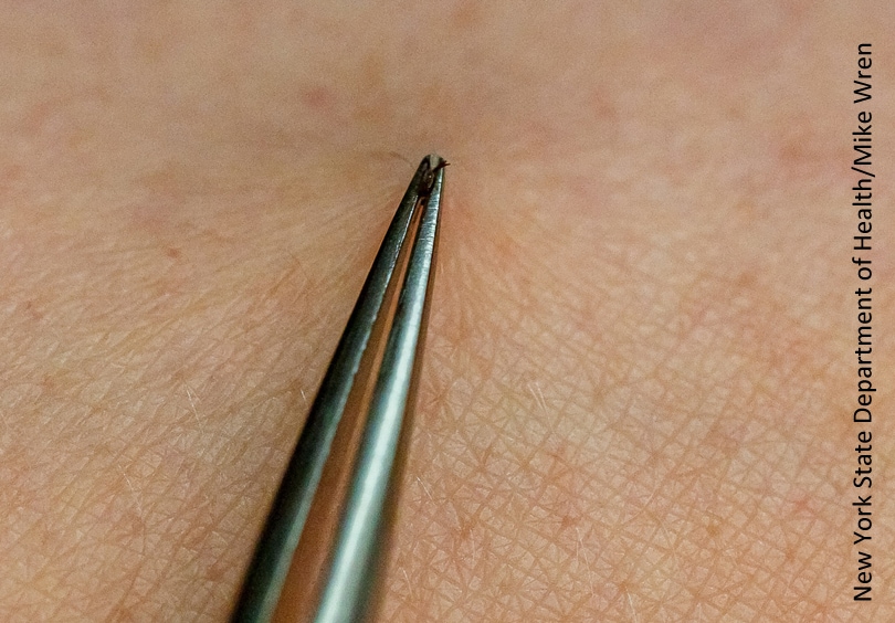 Photo from New York State Department of health showing tweezers being used to pull a tick out of skin.