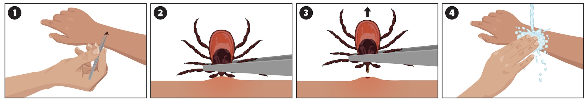 Illustration showing how to remove a tick (Ixodes scapularis pictured).
