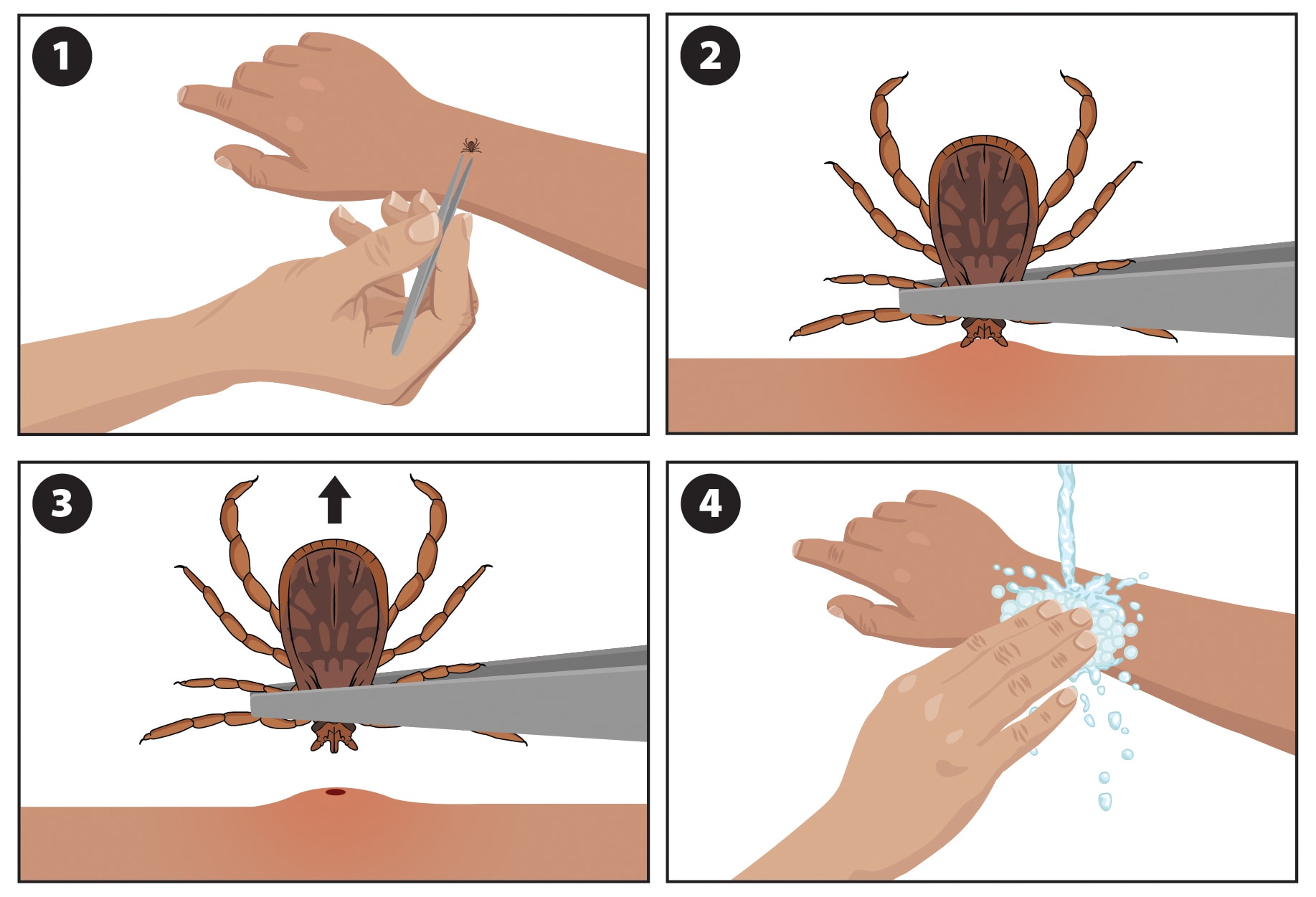Illustration showing how to remove a tick (Dermacentor variabilis pictured).