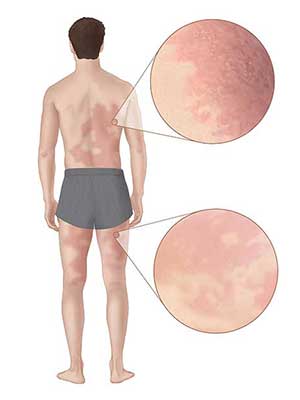 Illustration of a man with Alpha-gal Allergy rash on his back and legs