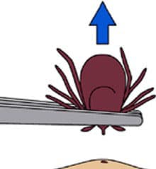 tweezers pulling a tick away from the skin in an upward motion
