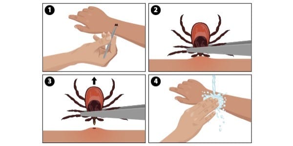 Tick Removal | Ticks | CDC