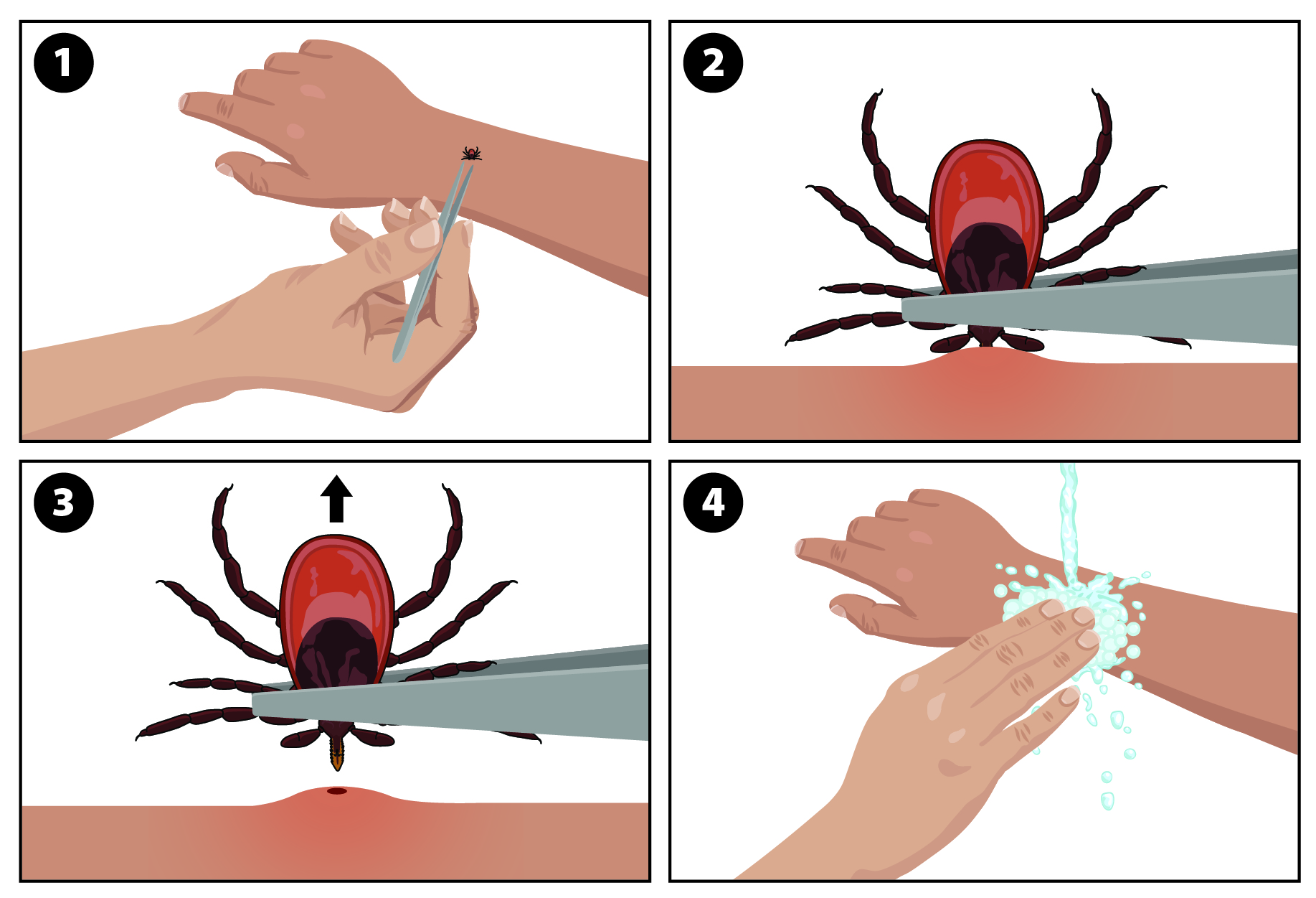 Illustration showing how to remove a tick (Ixodes scapularis pictured).