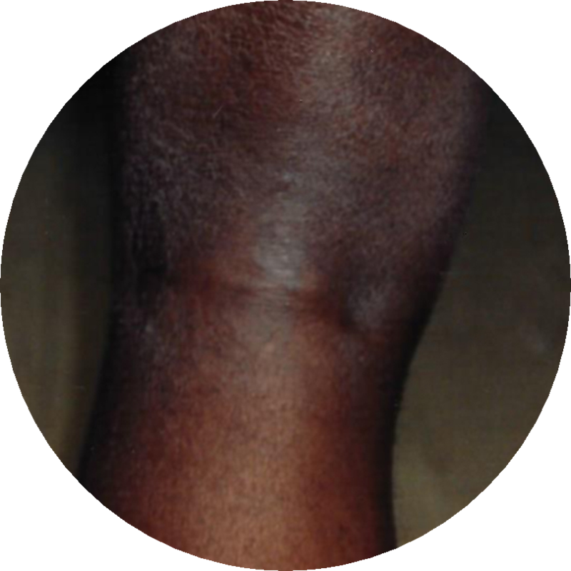 EM Left Posterior Thigh Popliteal Fossa