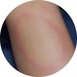 Classic EM—Circular red rash with central clearing that slowly expands