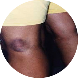 Purple lesion on back of knee