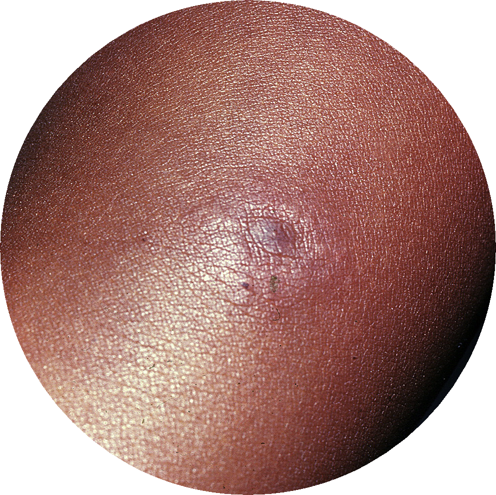 early, expanding erythema migrans with nodule