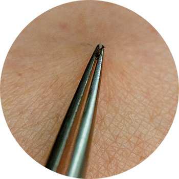 Embedded tick being removed with a pair of tweezers