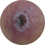 Scabbed region at the site of a tick bite called an eschar