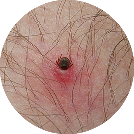 Embedded tick in person's skin with mild allergic reaction