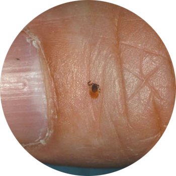 Small embedded tick on persons thumb