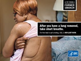 A Tip From a Former Smoker: After you have a lung removed, take short breaths. For free help to quit smoking, call 1-800-QUIT-NOW.
