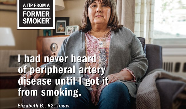 Elizabeth B., 62, Texas - I had never heard of peripheral artery disease until I got it from smoking.