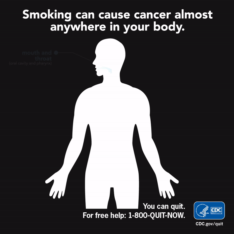 Smoking can cause cancer almost anywhere in your body: Mouth and throat (oral cavity and pharynx); Esophagus, voice box (larynx); Lung, bronchus, and trachea; Acute myeloid leukemia; Liver; Kidney and renal pelvis; Stomach; Uterine cervix; Pancreas; Urinary bladder; Colon and rectum