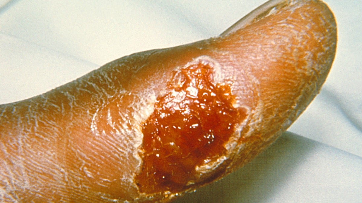 An ulcer on a person's thumb caused by Francisella tularensis.