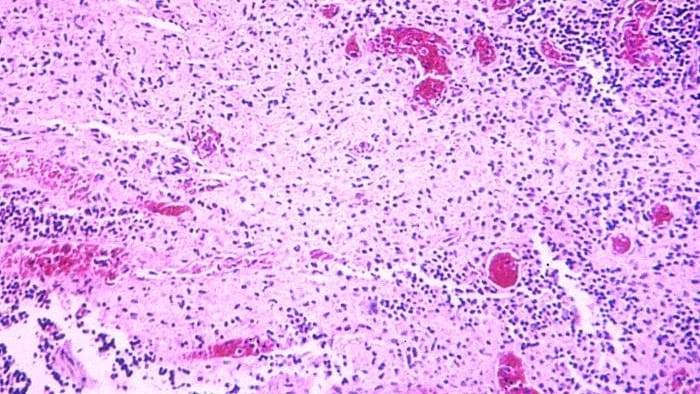 Photomicrograph of a gallbladder tissue specimen in a case of typhoid fever. Image shows signs of inflammation, neutrophilic infiltrate, and generalized tissue necrosis.