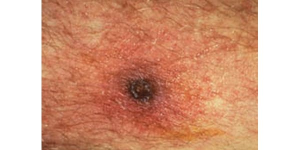 Scrub Typhus | Typhus Fevers | CDC