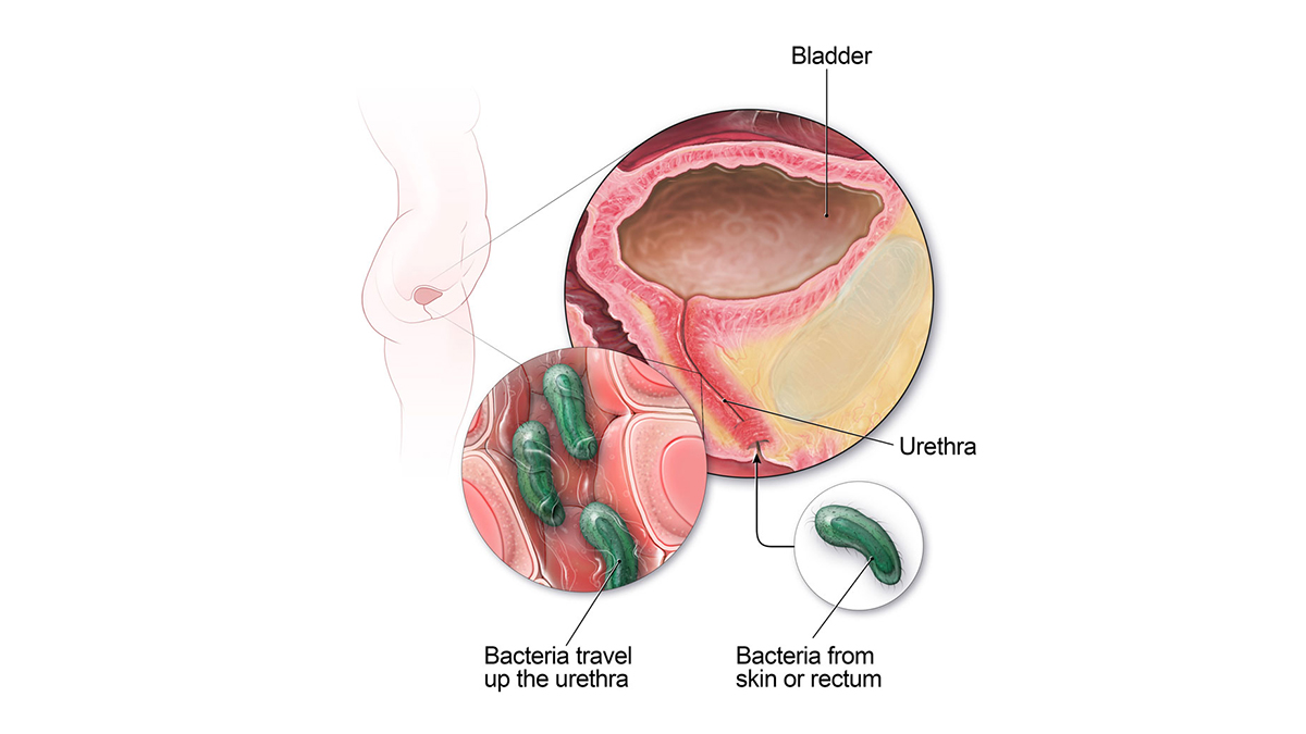 urinary system case study answers