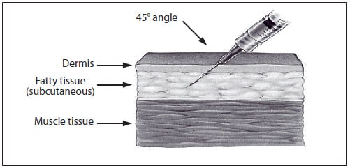 This drawing shows subcutaneous needle insertion into a cross-section of skin. The needle is inserted at a 45-degree angle and penetrates the dermis and fatty tissue (subcutaneous) but not the muscle tissue.