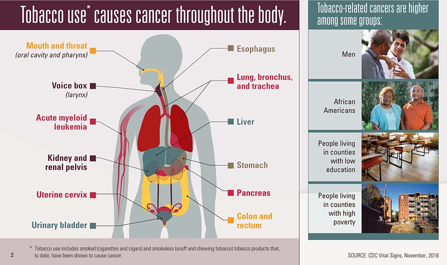 Infographic: Tobacco use* causes cancer throughout the body