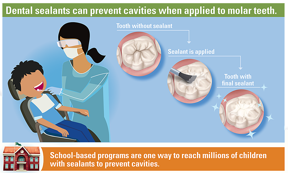 Graphic: Dental sealants can prevent cavities when applied to molar teeth.