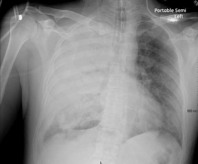 Radiograph image of a set of lungs with welder's anthrax, which shows up as black on the xray