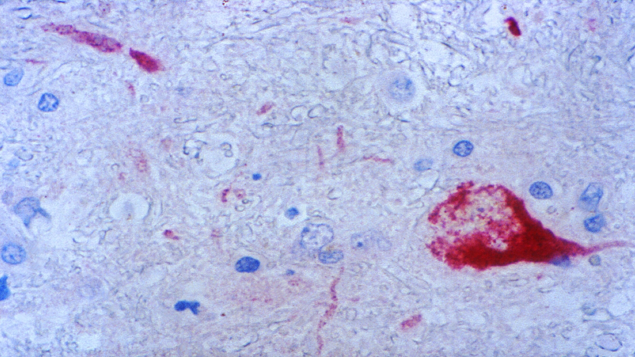 Using a histochemical technique in processing this tissue specimen, this photomicrographic image revealed the presence of the West Nile virus.