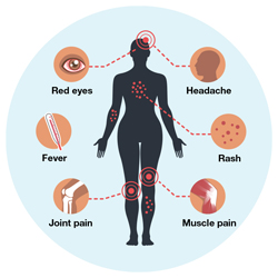 Zika Virus Symptomen