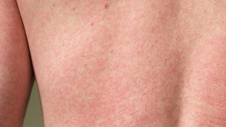 Posterior view of a patient’s back, captured in a clinical setting, upon presenting with this blotchy rash. After a diagnostic work-up, it was determined that the rash had been caused by the Zika virus.
